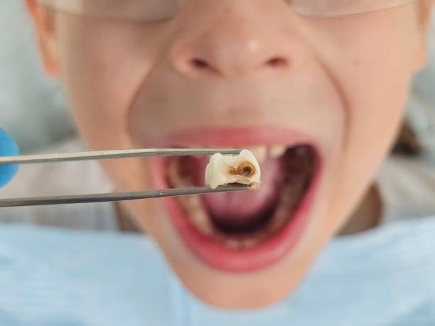 Best Emergency Tooth Extraction in Pocomoke City, MD